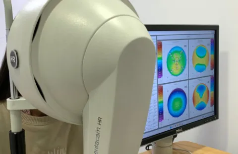 La paquimetría óptica permite evaluar si el espesor corneal es normal o, por el contrario, requiere de control y manejo ocular