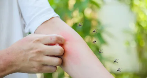 Picadura de mosquito