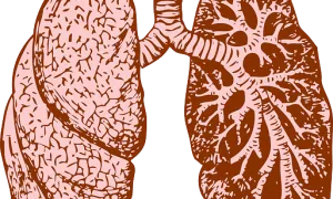 La bronquiolitis ya tiene vacuna