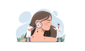 Lunares y cáncer de piel
