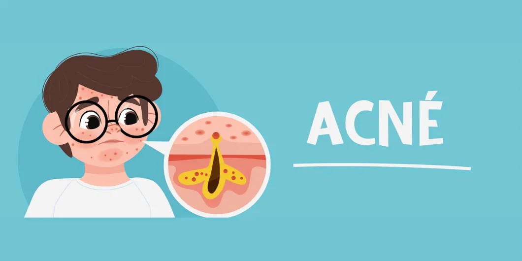 ¿Qué es el acné?