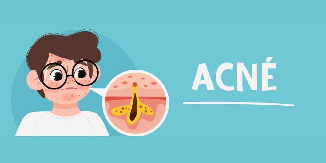¿Qué es el acné?