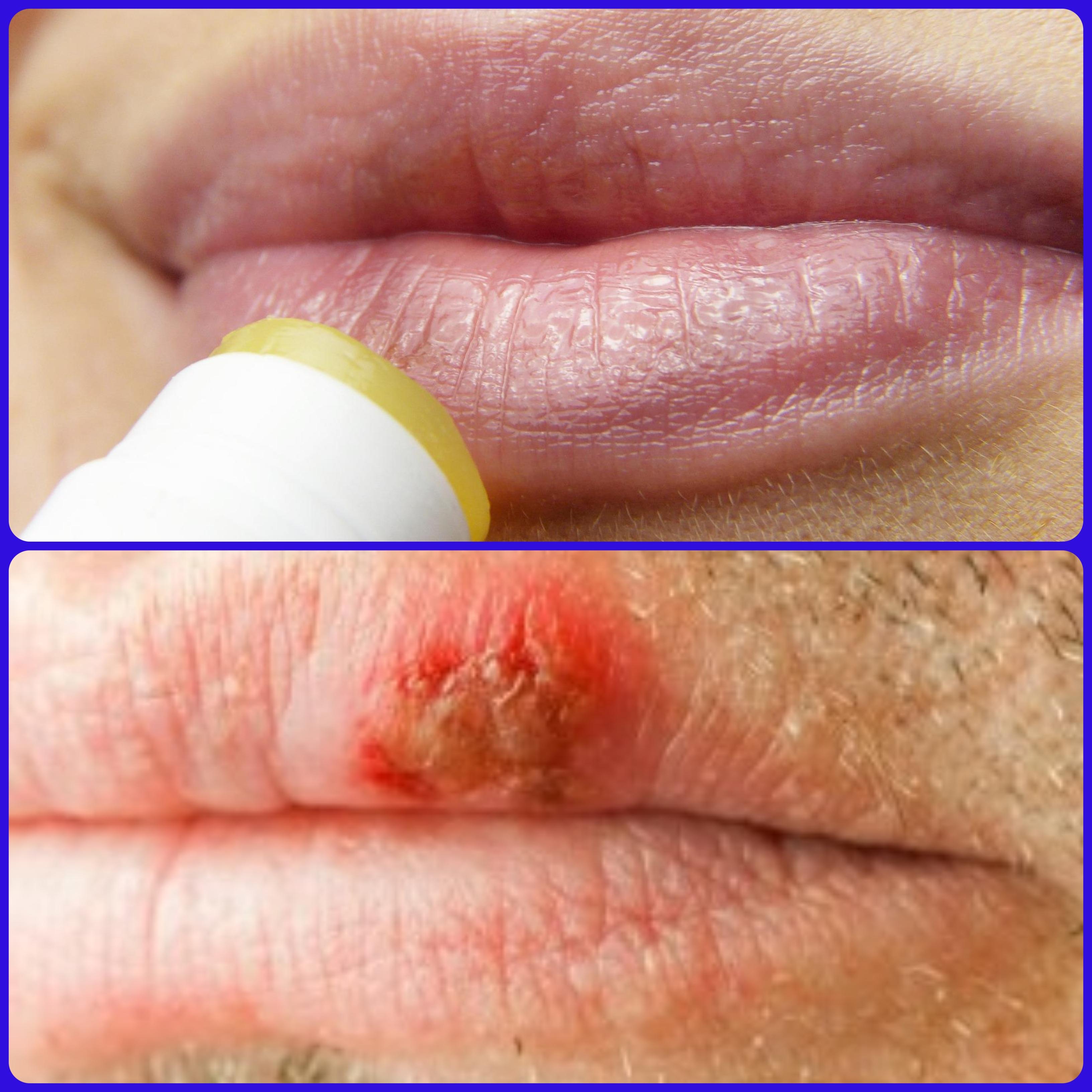 Dime que comes y te diré si el virus del herpes combates